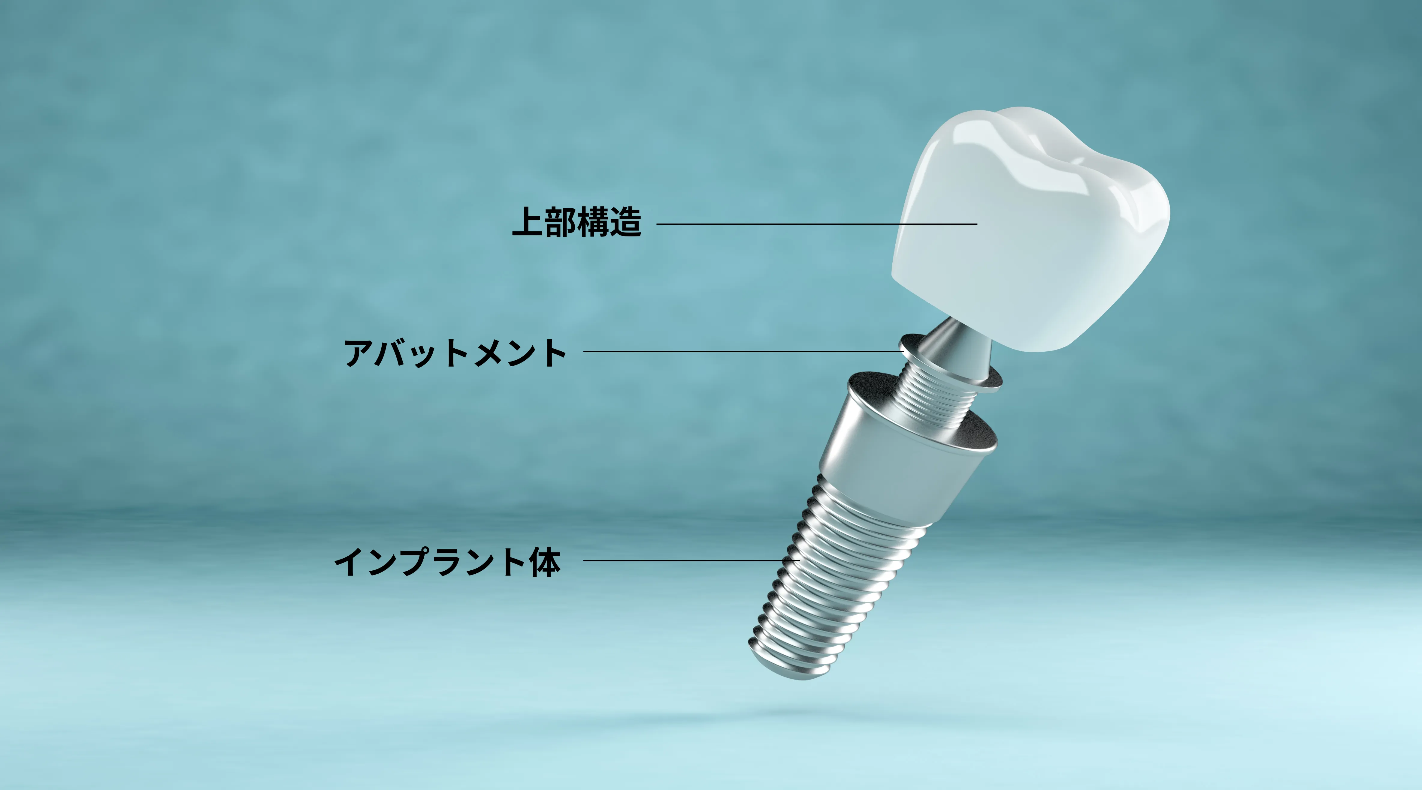 インプラントの構造